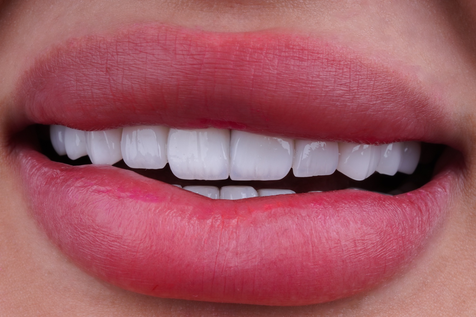 Ceramic restoration case by Dr. Jihad Sameer