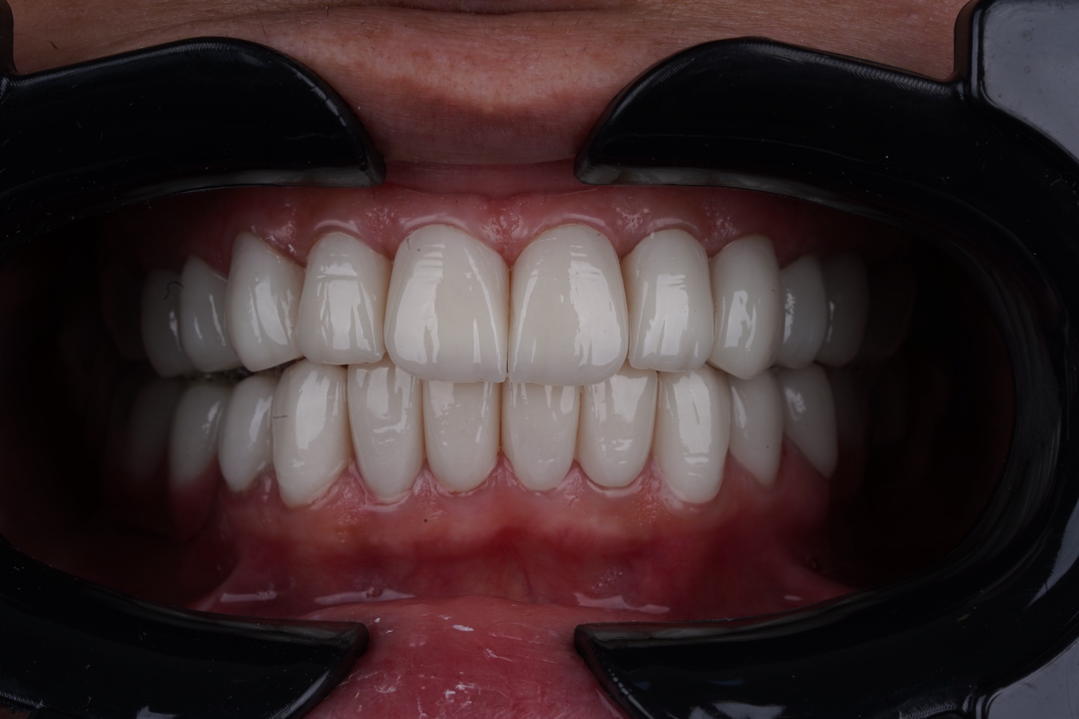 After treatment, dental implant case by Dr. Jihad