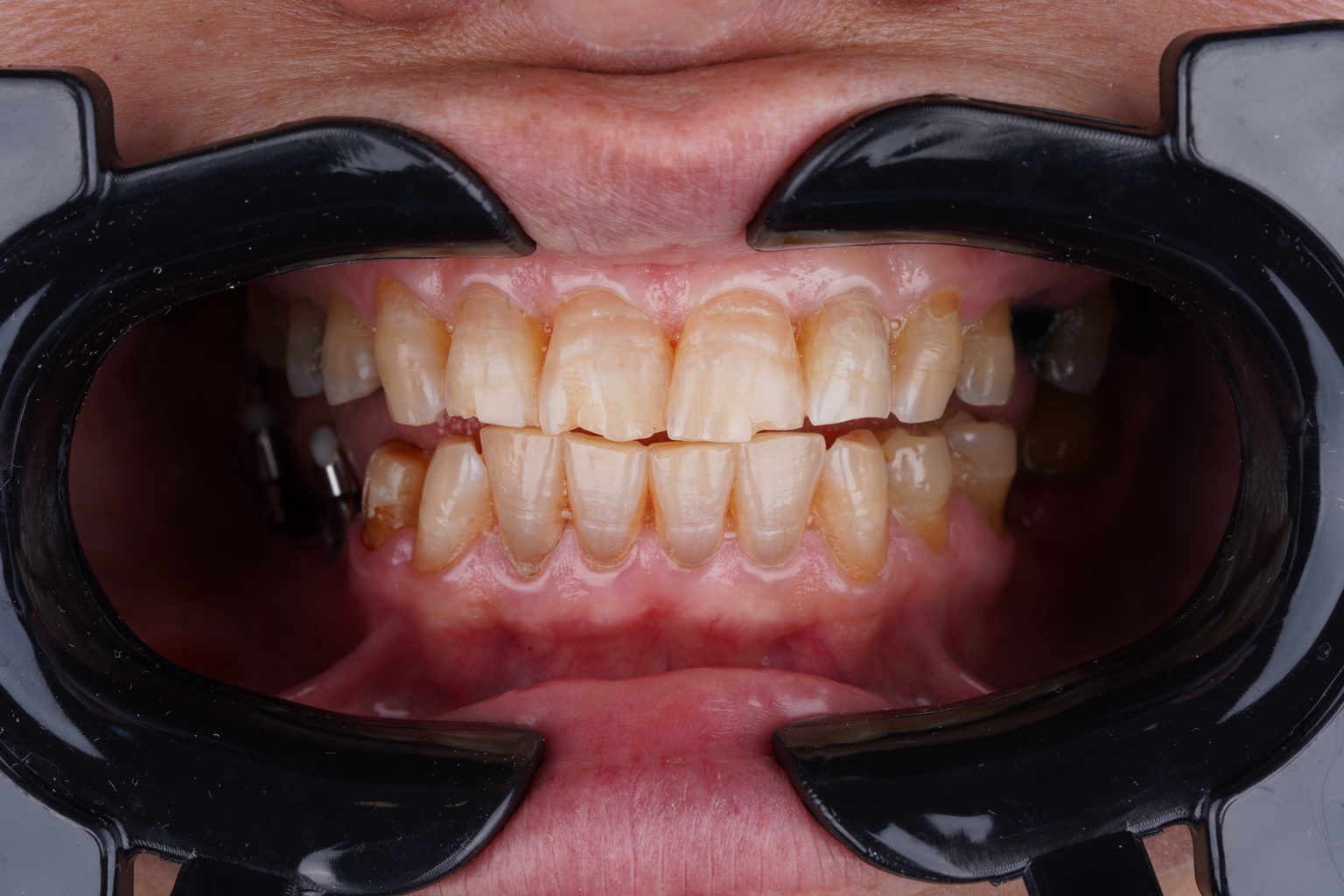 Before treatment, dental implant case by Dr. Jihad